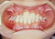 Ortodontia antes